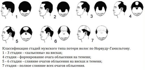Почему лысеют мужчины: основные причины и методы лечения