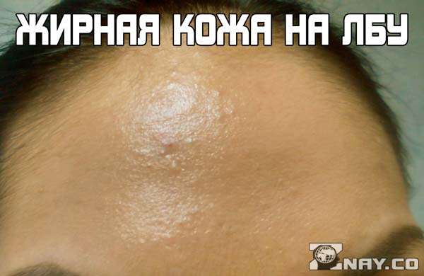1535054846 zhirnyy lob kak izbavitsya 5 - Жирный лоб как избавиться в домашних условиях