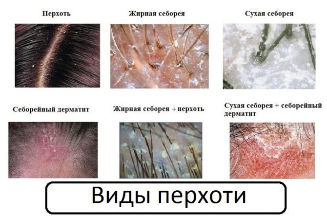 Что такое трубчатая перхоть? Фото, причины появления и симптомы, как ее вылечить
