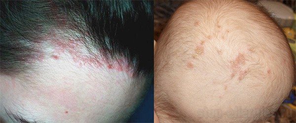 Причины появления сыпи и зуда на голове у взрослого и решение проблемы