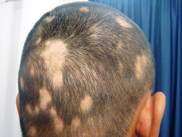 алопеция у детей причины и лечение