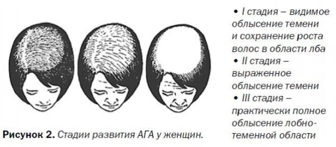 Выпадение волос у женщин – как его распознать и с ним бороться