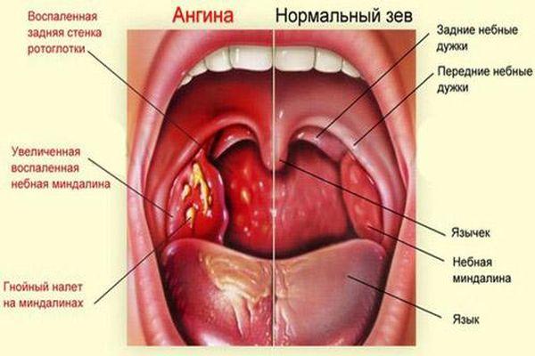 ангина и связки