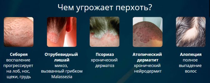 Что такое трубчатая перхоть? Фото, причины появления и симптомы, как ее вылечить