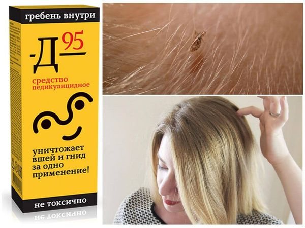 Лечение вшей и гнид в домашних условиях – как и чем можно вылечить педикулез
