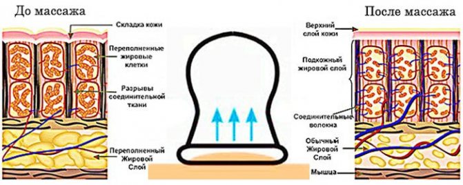 Всё про баночный массаж — эффективный способ лечения целлюлита и других заболеваний
