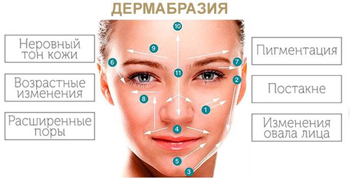 Для чего применяют дермабразию