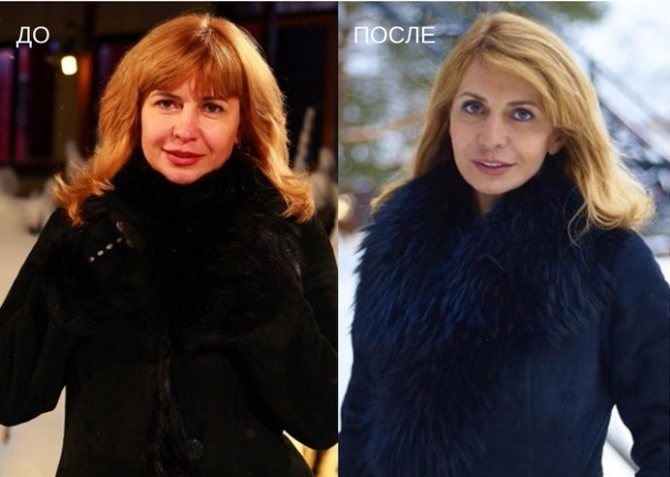 Татьяна Строкова до и после пластики: какие операции делала звезда Дома-2 из Воронежа