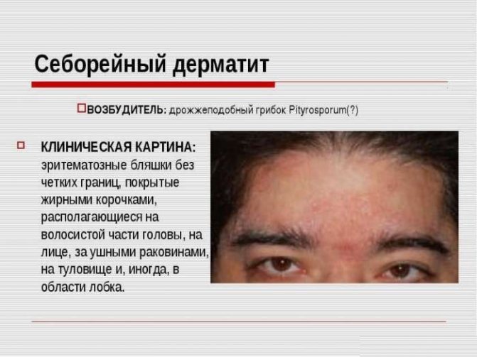 7 шампуней при себорее – для лечения дерматита кожи головы – лучшие