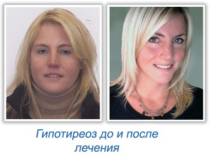 Гипотиреоз до и после лечения