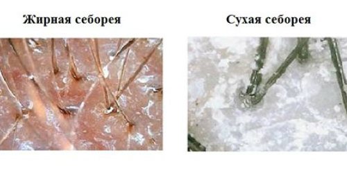 Как убрать перхоть с головы в домашних условиях быстро и эффективно: лечебные шампуни, масла, морская соль, сода