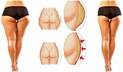 Как убрать ушки на бедрах: пошаговая инструкция