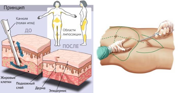 Как убрать ушки на бедрах за неделю: упражнения, липосакция, баночный массаж, обертывания