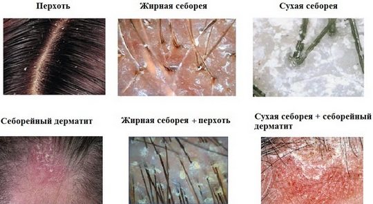 Капсульное наращивание волос. Виды, плюсы и минусы, последствия, на сколько хватает, сколько стоит, как снять. Что лучше: капсульное или ленточное
