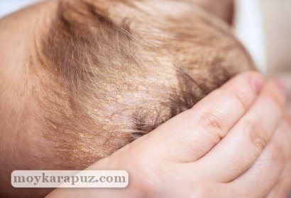 Корочки у грудничка