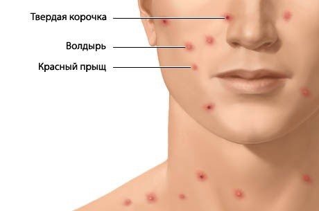 Красные точки на теле - что это, причины, как лечить у взрослых, беременных и детей