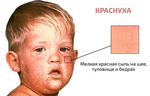 Красные точки на теле - что это, причины, как лечить у взрослых, беременных и детей
