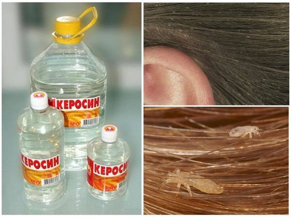 Лечение педикулеза керосином