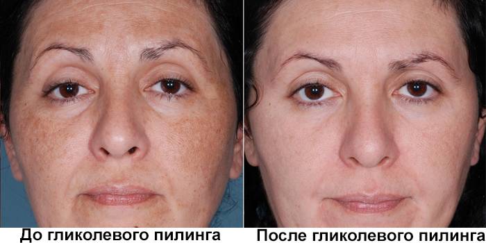 Лицо до и после гликолевого пилинга