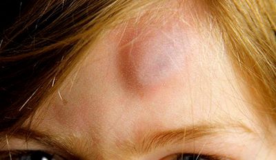 Шишка на лице после удара не проходит. Нестандартные методы лечения