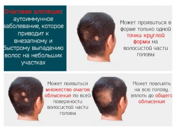 очаговая алопеция симптомы