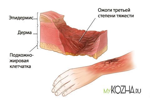 ozhog tretej stepeni - Розовая кожа после ожога