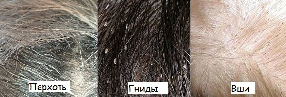 Педикулёз признаки, лечение и профилактика