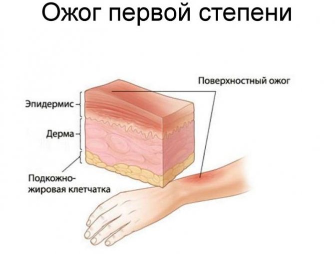 pervaja stepen - Розовая кожа после ожога