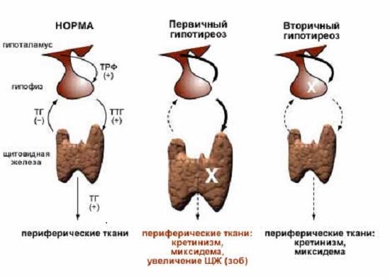 Заболевания щитовидной железы и их влияние на выпадение волос