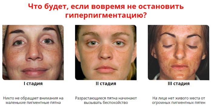 Последствия гиперпигментации