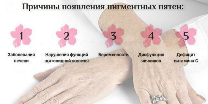 Причины появления пигментных пятен