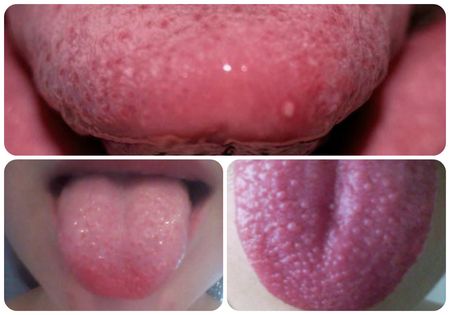 Прыщи на языке