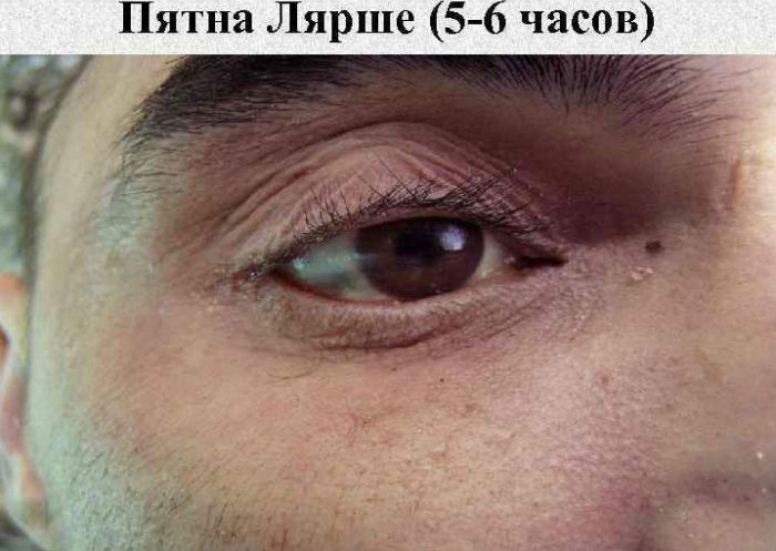 Пятна Лярше фото