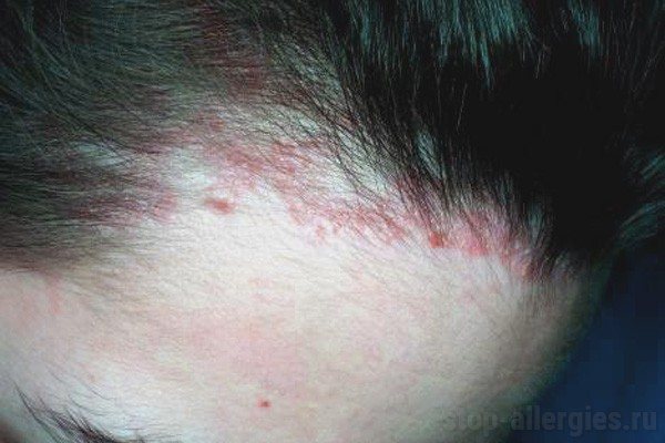 Причины появления сыпи и зуда на голове у взрослого и решение проблемы