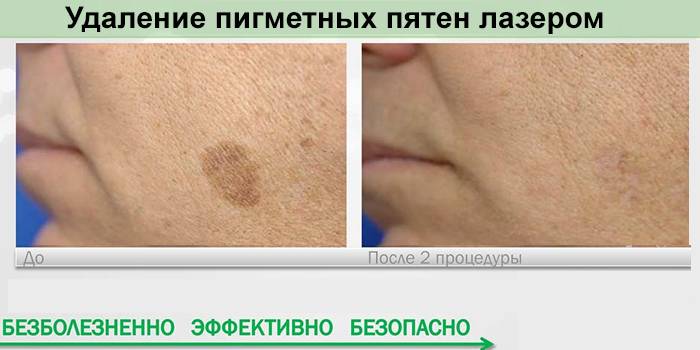 Результат удаления пятная лазером