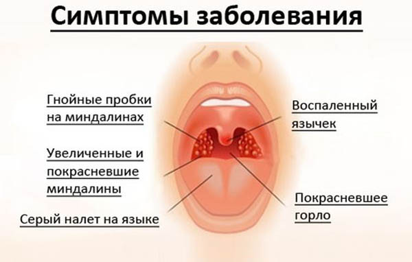 Как быстро вылечить горло в домашних условиях: народные средства