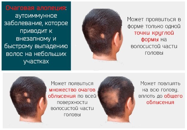 Средства от выпадения волос у мужчин. Рейтинг лучших в аптеке, народные, шампуни, витамины. Цены