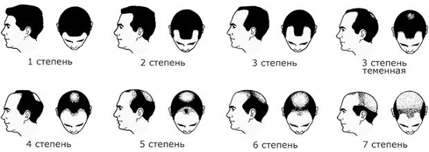 Степени облысения