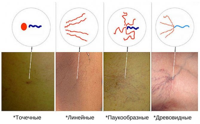Варикозная сетка на ногах: симптомы с фото и методы лечения