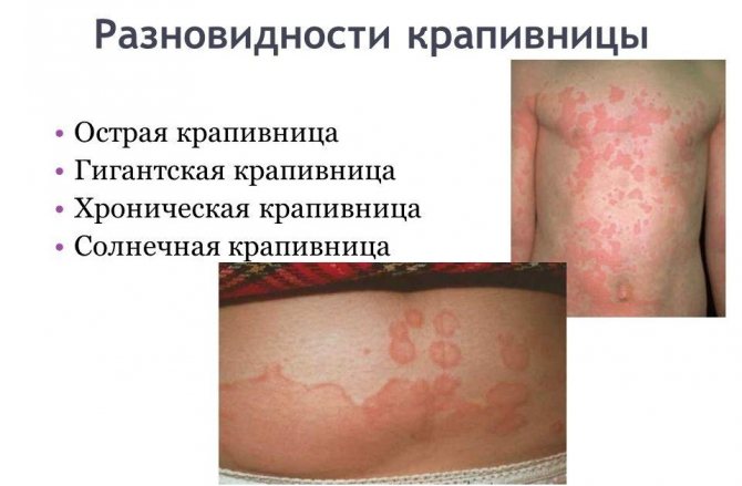 Как проявляется аллергия на краску для волос, бровей, ресниц: фото последствий