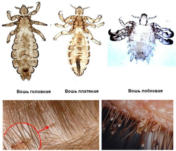 виды вшей