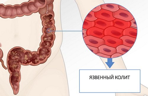 Язвенный колит